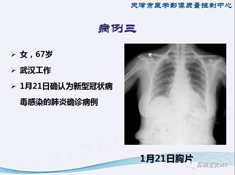 全球新型冠状肺炎最新报告图，疫情现状与趋势深度分析